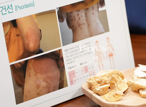 생기한의원 건선 페이지에서 정리한 농포성 건선 특징